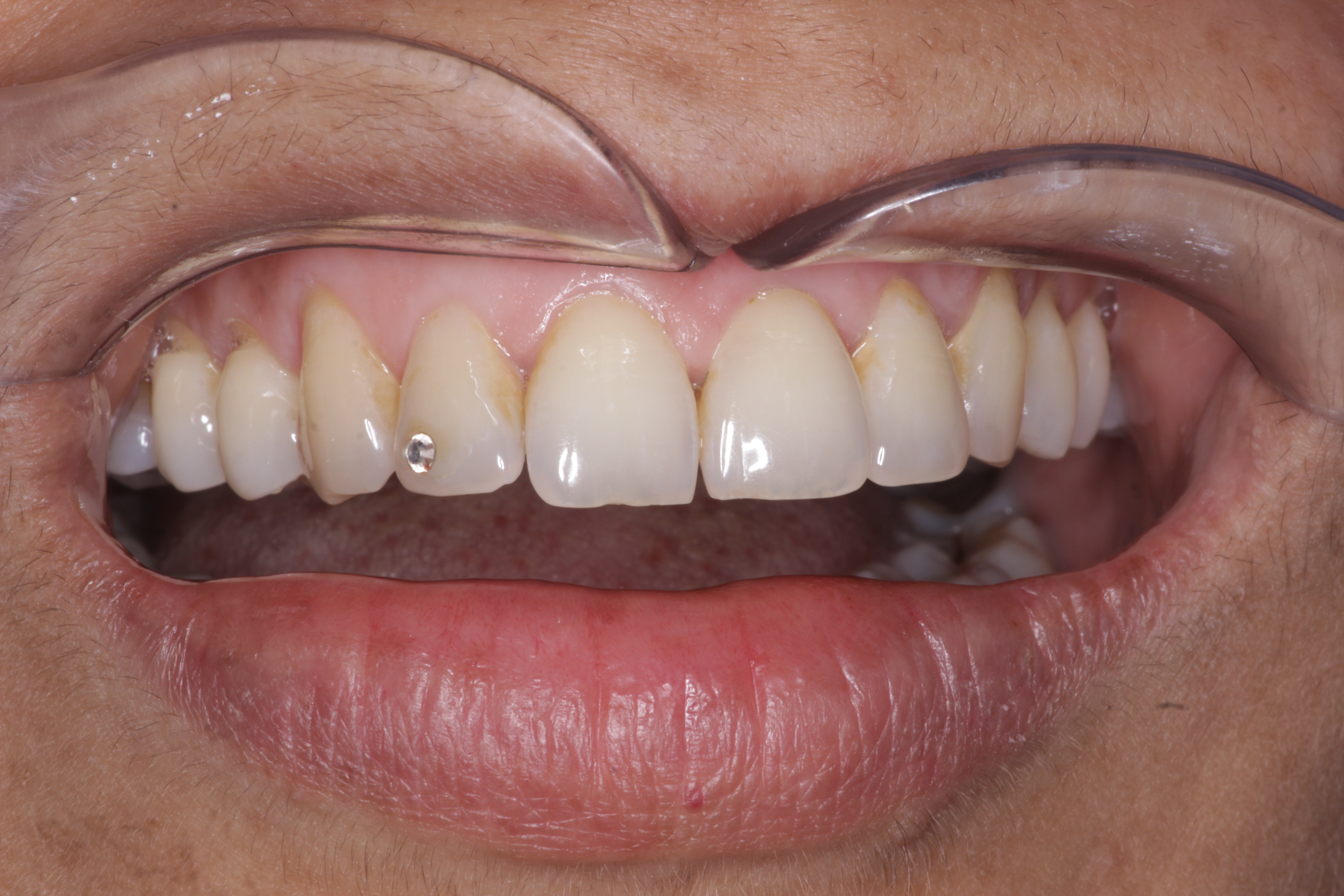 Tooth Jewellery Patient